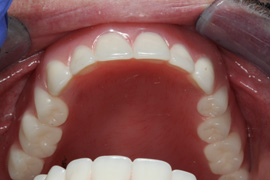 After Implant Overdenture