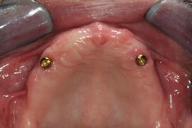 Before Implant Overdenture