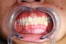 Before Orthodontics