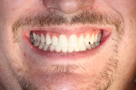After Orthodontics