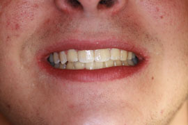 After Orthodontics